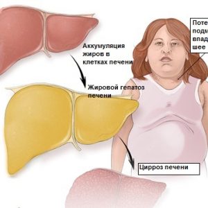 Жировой гепатоз печени: причины, симптомы и лечение