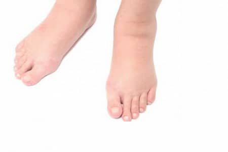 Отек мягких тканей ног свидетельствует о развитии правожелудочной недостаточности