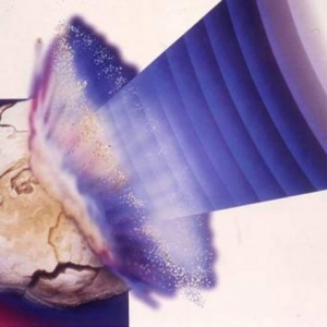 Дробление камней в желчном пузыре при помощи лазера