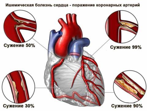 Наличие ИБС – одно из показаний для проведения рентгенографии сердца