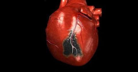 Инфаркт сопровождается нестерпимой жгучей болью в области левого подреберья.