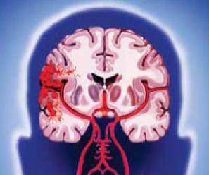 Кровоизлияние в ткани головного мозга