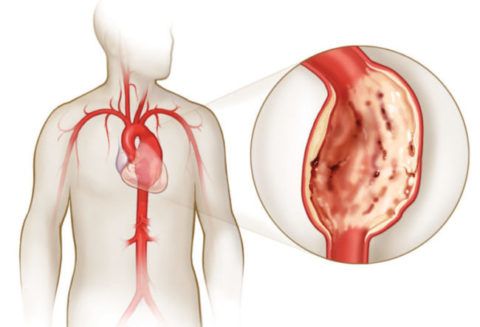 Главные симптоматические проявления атеросклероза аорты и сердца