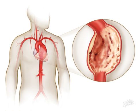 Тромб, мешающий нормальной циркуляции крови, приводит к инфаркту