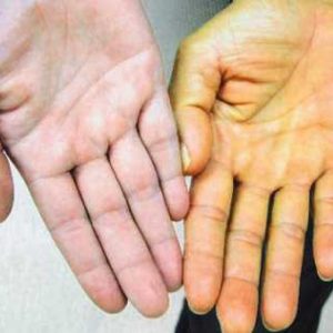 Симптомы гепатита А у взрослых и детей