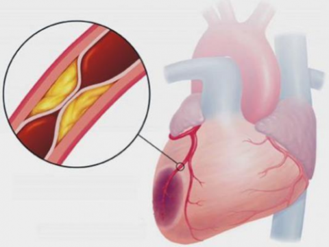 Нарушение кровоснабжения мышц сердца