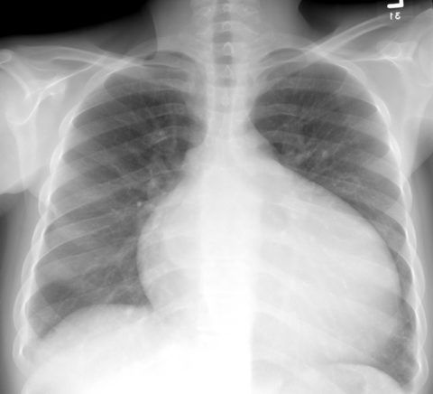 На рентгеновском снимке видно увеличение размеров сердца