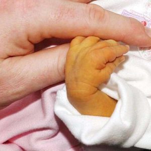 Желтуха у новорожденных: причины, последствия и лечение
