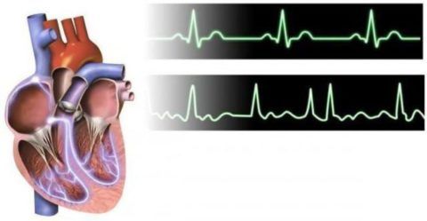 При асистолии прекращается биоэлектрическая активность сердца