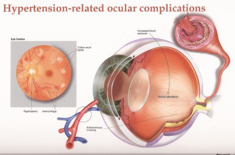 Воздействие высокого давления на сосуды глаза — отек диска, кровоизлияния, «ватные пятна»