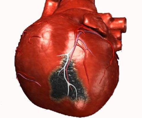 На фото пораженная некрозом область сердца при инфаркте миокарда.