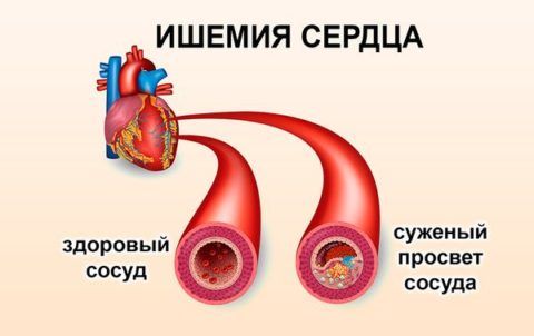 Ишемическая болезнь сердца характеризуется сужением просвета кровеносных сосудов и увеличением кровяного давления в органе.