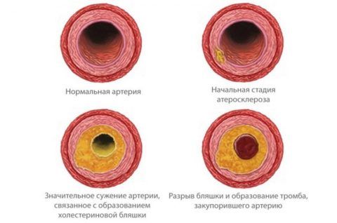 Атеросклеротические поражения артерий