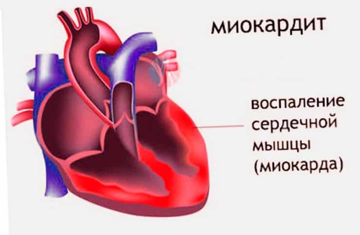 Миокардит – воспаление области сердечной мышцы.