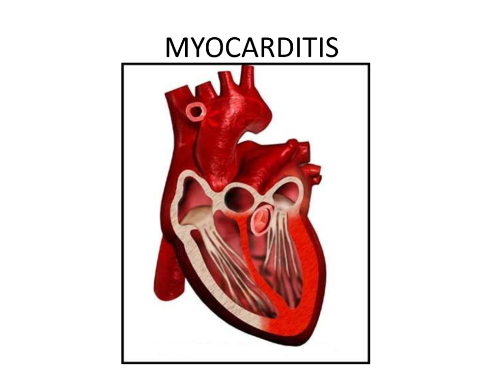 Миокардитом называют воспалительное поражение мышечной ткани сердца