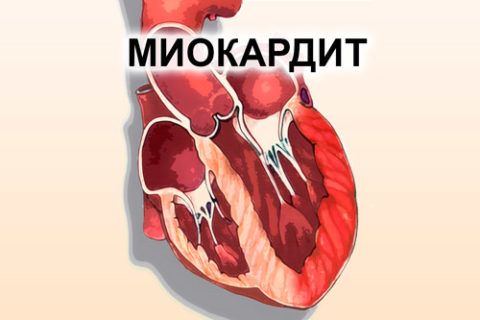 Миокардит обусловлен воспалением сердечной мышцы, провоцирующим тянущую боль и одышку.