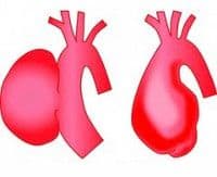 Аневризма восходящей аорты сердца