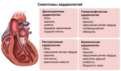 Признаки основных видов кардиопатий