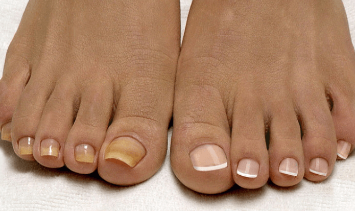 Грибок ногтя безопасное лечение народными средствами
