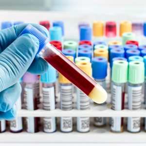 Как правильно сдавать анализ крови и кала на описторхоз