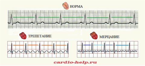 Схематические ЭКГ у здорового сердца и при разных видах фибрилляции его предсердий