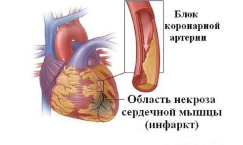 Механизм развития инфаркта