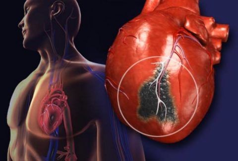 экстрасистолия органического характера возникает на фоне поражения сердечной мышцы и сосудов.
