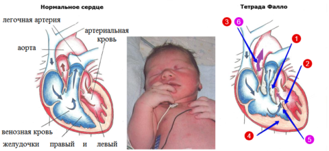 Tetrad («красная» нумерация) аномалий сердца, типичных для синюшной болезни