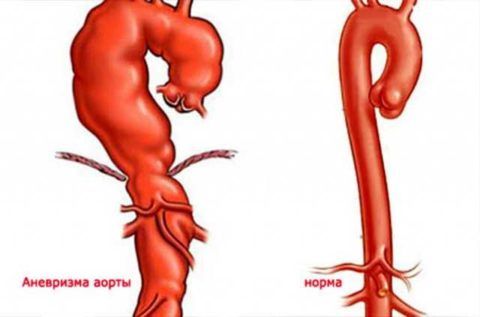Аневризма аорты – состояние, способное привести к разрыву самой аорты и смерти.