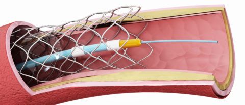 Баллонная ангиопластика почечной артерии