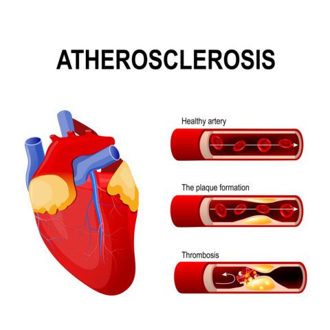 Атеросклероз – причина патологии.