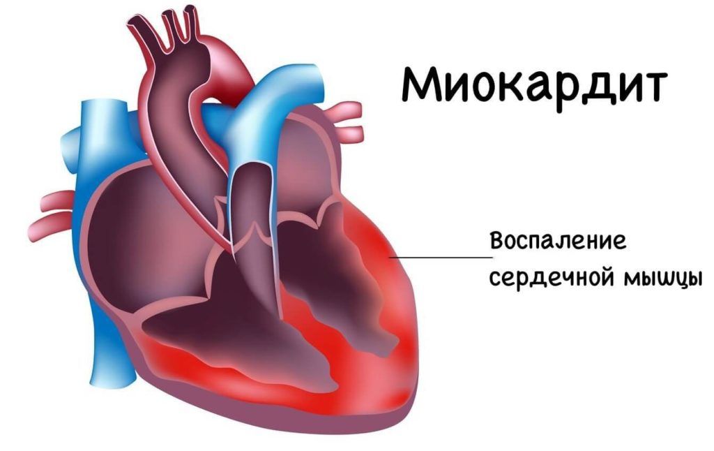 Увеличение сердечной мышцы вследствие воспаления