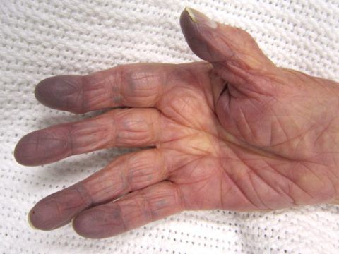 Цианоз пальцев рук