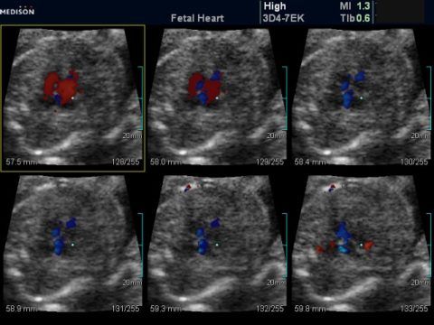 Многочисленные аномалии межжелудочковой перегородки сердца плода (20 неделя)