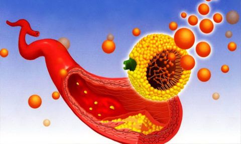 Эффективность лечебных методик атеросклероза кровеносных сосудов в организме человека