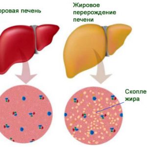 Жировой гепатоз: причины возникновения, симптомы и лечение