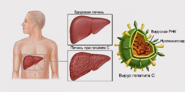 Что собой представляет гепатит С и как он передается?
