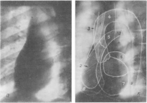 Рентгенограмма (а) и схема (б) сердца и крупных артерий (в левой передней косой проекции)