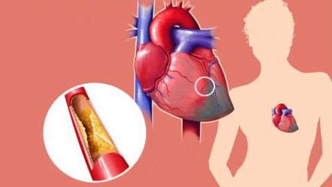 Одной из главных причин патологии является ишемическая болезнь сердца