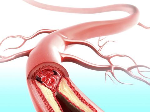 Влияние увеличенного артериального давления на кровеносные сосуды