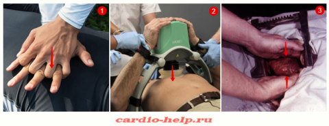 Надавливания руками на грудину (1), аппарат для непрямого массажа сердца (2), внутренний массаж сердца (3)