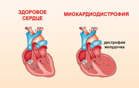 Отличия здорового и пораженного сердца