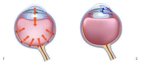 Типы глаукомы, патологии для которой характерен высокий офтальмотонус