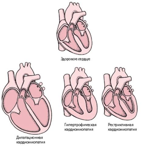 Схематическое изображение здорового и больного сердца