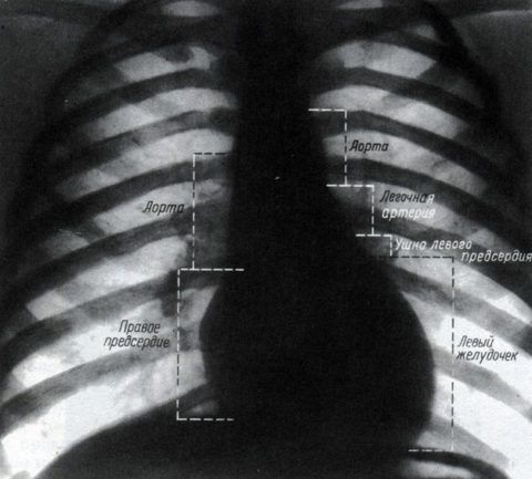 Рентген грудной клетки