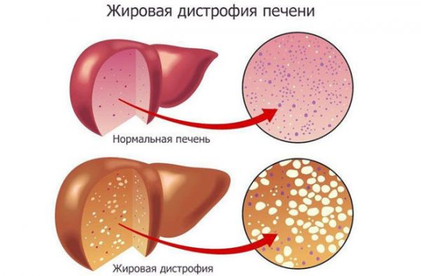 Особенности протекания стеатоза печени