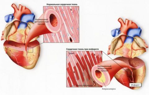 Причиной хронической СЛН является атеросклероз, вследствие которого может развиться инфаркт.