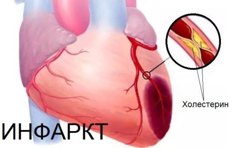 В зависимости от локализации поражения инфаркт делят на несколько типов.