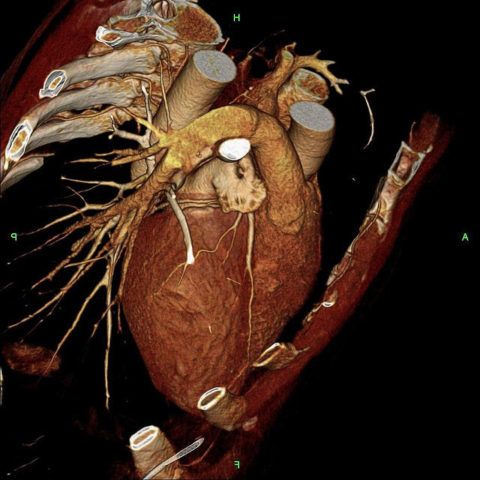 Трехмерный снимок сердца сделанный при помощи томографии