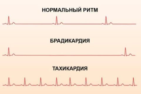 Пример того как выглядят изменения пульса на кардиограмме